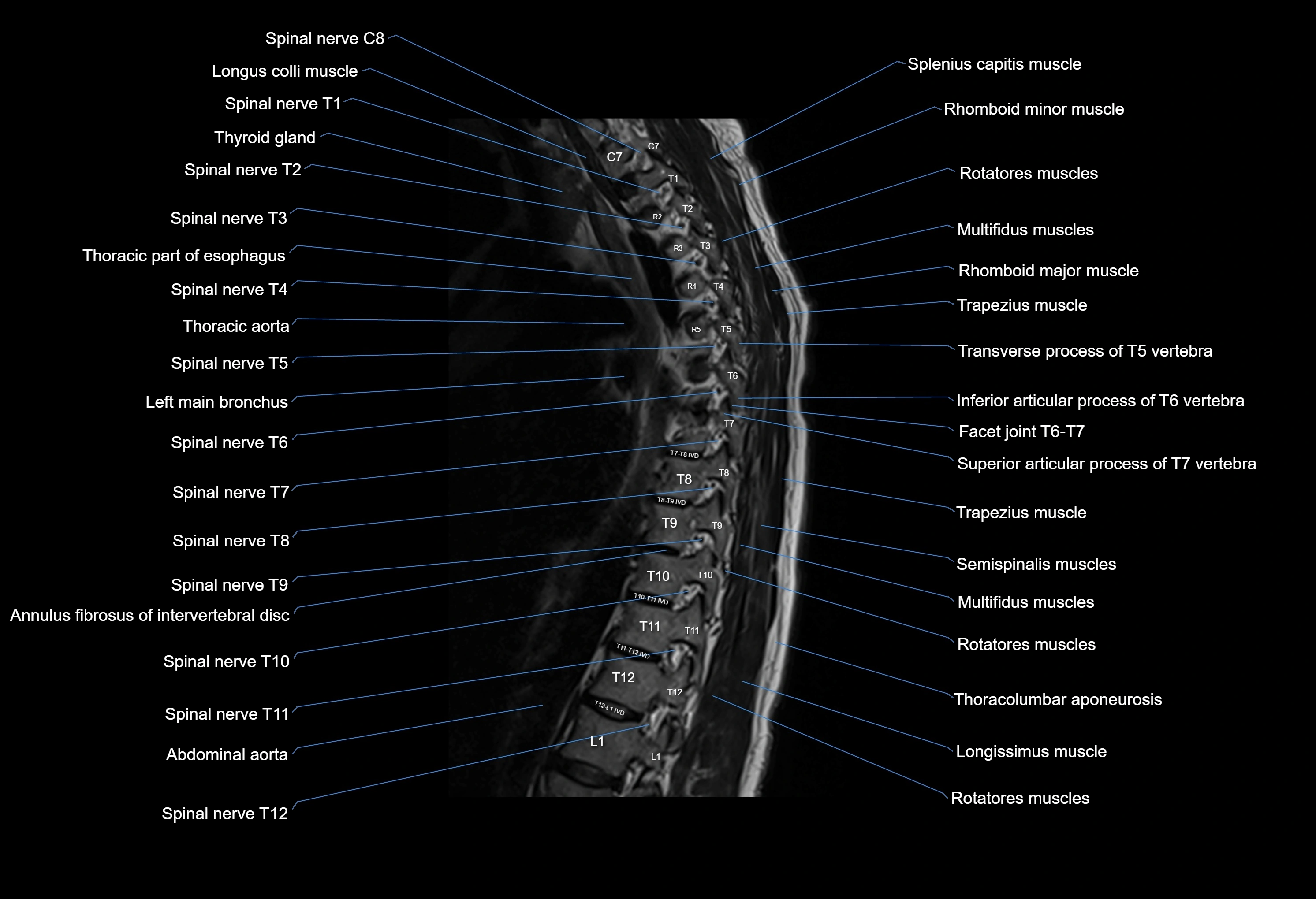 MRI thoracic spine sagittal  cross sectional anatomy 3T radiology  image-img-00001-00018.webp